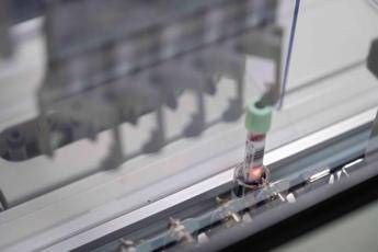 “Diagnosi precoce cancro pancreas: nuovo test del sangue in arrivo”